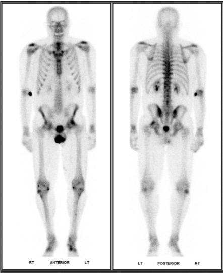 Normal bone scan